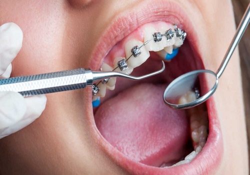 ارتودنسی-دندان های بالا