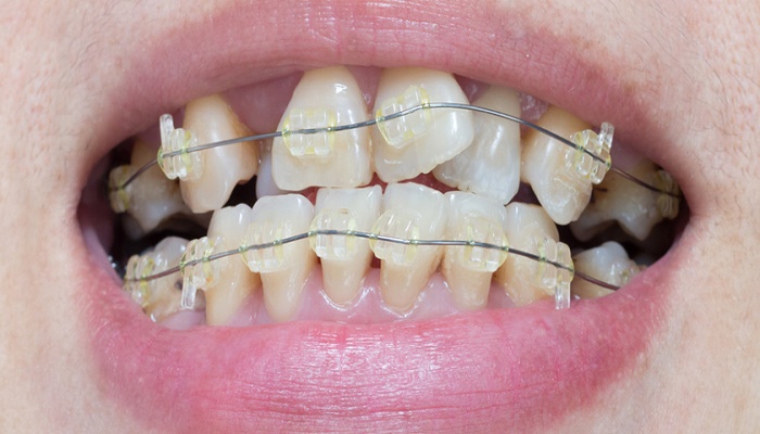 ارتودنسی دندان کج