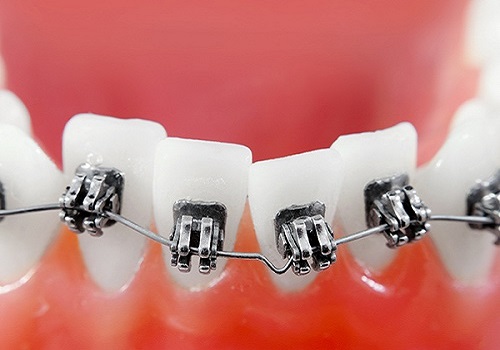 ارتودنسی-دندان-کج