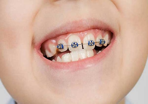 ارتودنسی-تک دندان