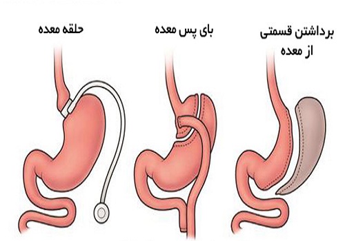 عمل های-لاغری-جدید