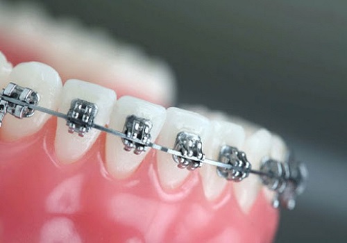 ارتودنسی-دندان-ایمپلنت