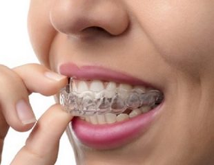 ارتودنسی بدون کشیدن دندان - بی سیم