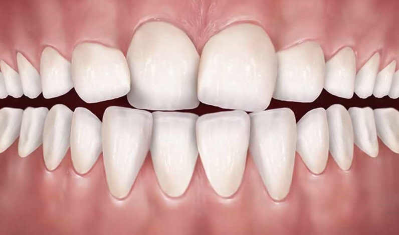 ارتودنسی-دندان-کج