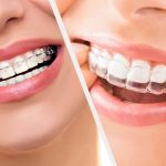 ارتودنسی ثابت یا نامرئی برای دندان