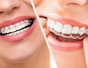 ارتودنسی ثابت یا نامرئی برای دندان