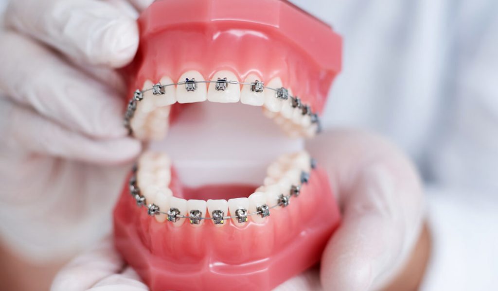 ارتودنسی ثابت دندان 