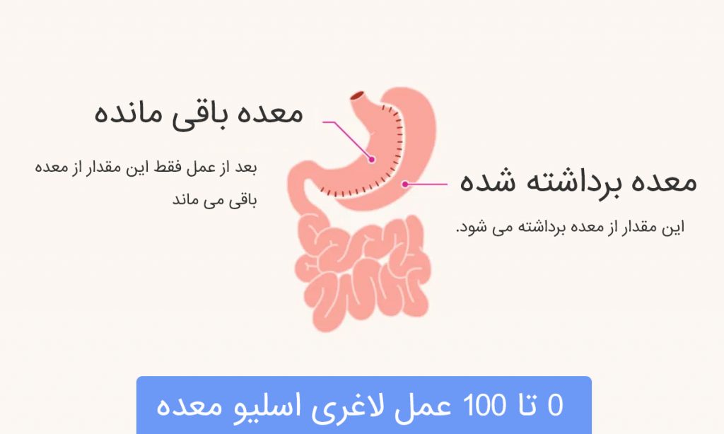 تصویر شاخص عمل اسیلو معده