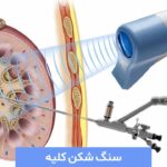 سنگ شکن کلیه