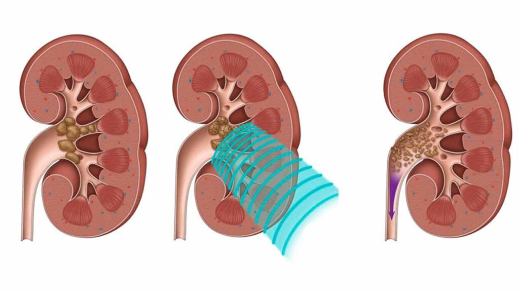 سنگ شکن کلیه چیست؟